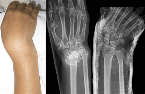 Styloid Process Of Ulna Fracture