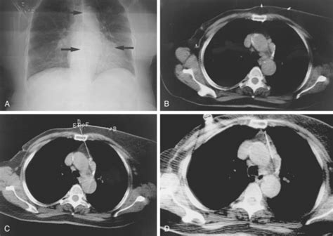 Percutaneous biopsy | Radiology Key