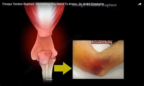 Triceps Tendon Rupture — OrthopaedicPrinciples.com