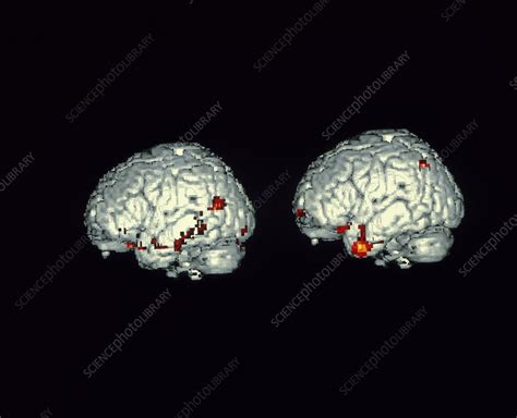 Language-cognition brain activity - Stock Image - P335/0058 - Science ...