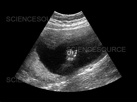 Photograph | Prenatal Ultrasound | Science Source Images