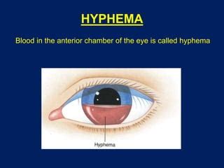 Hyphema | PPT