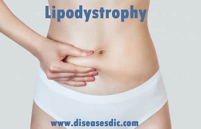 Lipodystrophy – Types, Risk Factors, Causes and Prevention