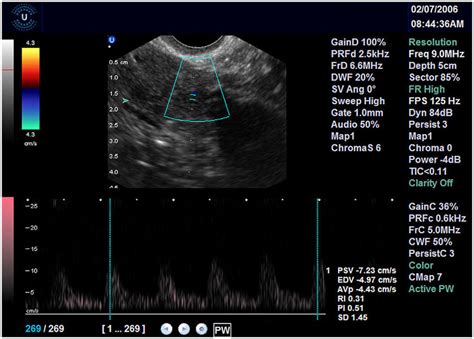 Uterine artery located with Doppler and measured ultrasound. Uterine ...