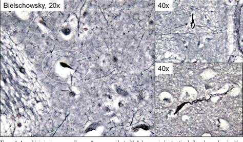 Figure 1 from Detection of diffuse axonal injury in forensic pathology ...