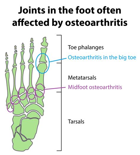 Osteoarthritis in the ankle and foot | Buxton Osteopathy Clinic