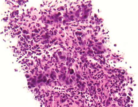 Biopsy of metastatic lesion involving the portacaval lymph node. | Download Scientific Diagram