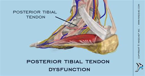 Posterior Tibial Tendon Dysfunction Stages