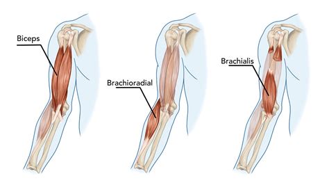 What Causes a Bicep to Tear: How to Prevent and Treatment Options ...