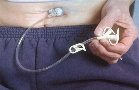 Percutaneous endoscopic gastrostomy (PEG): a practical approach for long term management | The BMJ