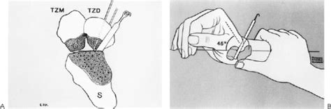 Triscaphe Degenerative Arthritis | Musculoskeletal Key