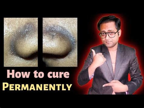 Black spot around nose and lips | Seborrheic melanosis treatment | Hindi - YouTube