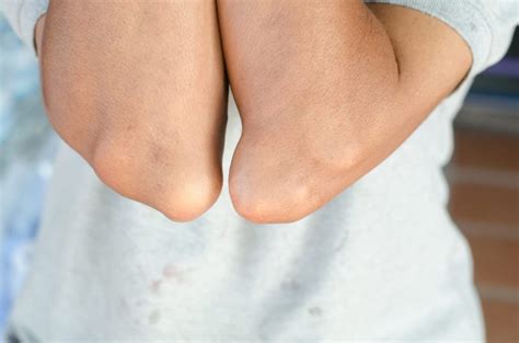 12 Signs of Gout - Facty Health