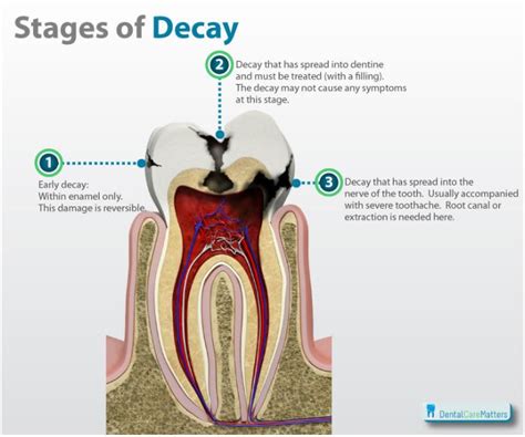 Southport Dental | 10 Facts You Should Know About Tooth Decay