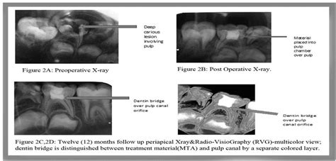 Sequential steps of Pulpotomy done by MTA | Download Scientific Diagram