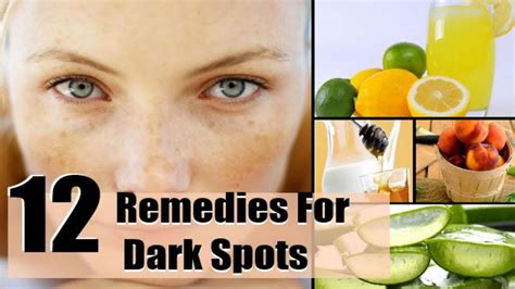 12 Effective Home Remedies For Dark Spots | Remove dark spots, Dark spots on face, Dark spots on ...