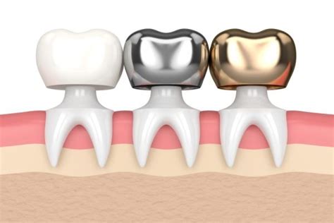 Types of Materials Available for my Dental Crown - Lasting Impressions Dental Group Houston TX