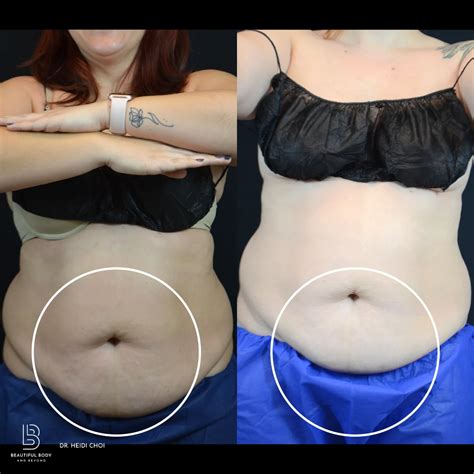 Unlock Your Dream Body with Coolsculpting® with Beautiful Body and Beyond in Corona, CA