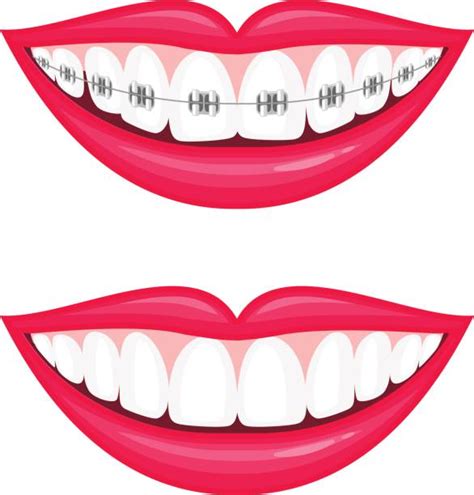 Free Braces Cliparts, Download Free Braces Cliparts png images, Free ...