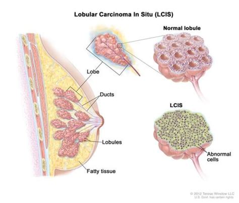 What is invasive lobular carcinoma (ILC)? – Life