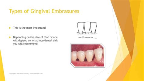 3 types of gingival embrasures