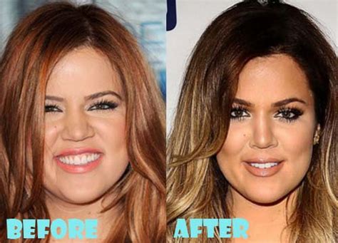 Khloe Kardashian Plastic Surgery Before and After Nose Job - Lovely Surgery