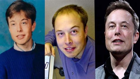 Real Truth About Elon Musk's Plastic Surgery - Facelift & Hair Transplant?