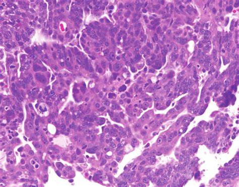 Representative H&E staining of high-grade serous ovarian carcinoma. | Download Scientific Diagram