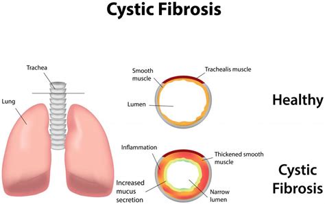 What Factors Affect Life Expectancy with Cystic Fibrosis?