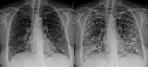 Chest X-ray Systematic Approach - Describing abnormalities