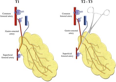 Omental Flow-Through Flap: Experimental Hemodynamic Study - Annals of Vascular Surgery