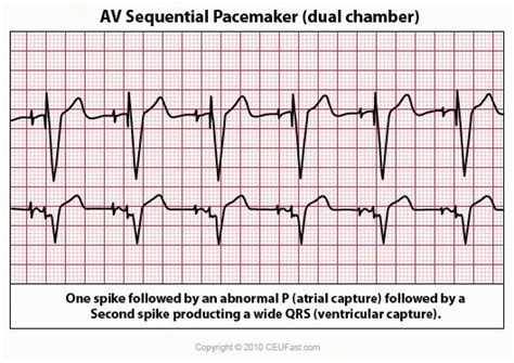 EKG Basics | Ekg, Ecg interpretation, Ekg interpretation