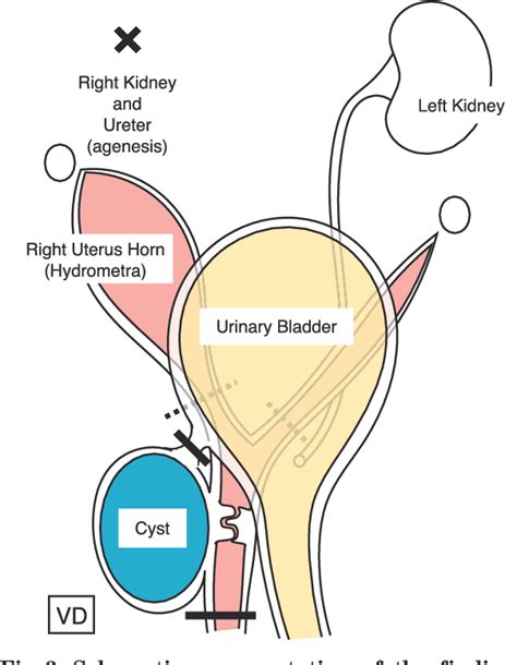 Gartner Duct Cyst Anatomy | Hot Sex Picture