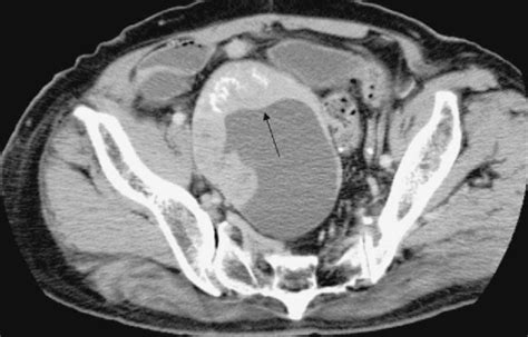 Figure 1 from Diffusion-weighted imaging of a malignant brenner tumor ...