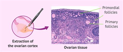 Ovarian cortex tissue