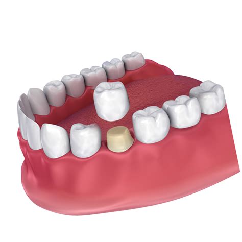 Causes of Damaged Dental Crowns - Missouri City, TX