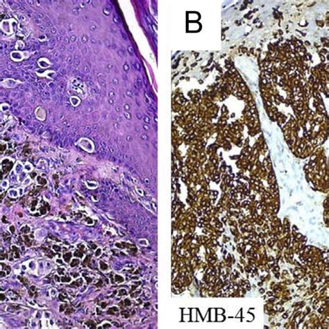 Histopathological appearance of cutaneous malignant melanoma in (A ...