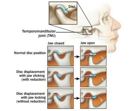 TMJ Issues Explained - Body of Life Health Centre