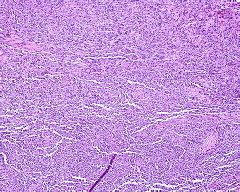 Clear Cell Sarcoma (Melanoma of Soft Parts)