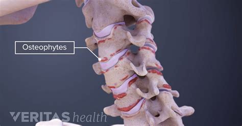 Osteophytes Definition | Back Pain and Neck Pain Medical Glossary