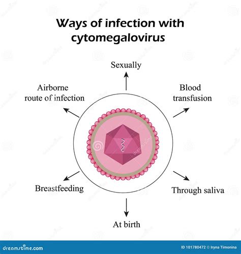 Cytomegalovirus. Diseases Caused by Cytomegalovirus. Infographics. Vector Illustration Stock ...