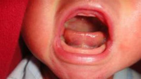 Petition · Posterior Tongue Ties to become a Key check upon a Baby's Birth or at 6 week Check Up ...