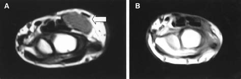 MRI findings of a patient with synovial sarcoma (Case 2) arising from ...