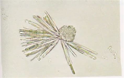 Amorphous Phosphate Crystals In Urine