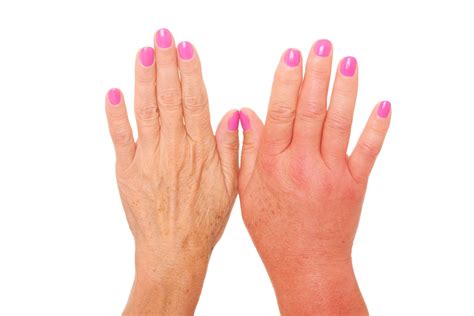 Psoriatic Arthritis Hand and Finger Symptoms