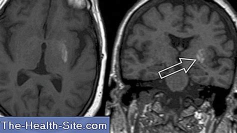 Ballism: Síntomas, Riesgos, Tratamiento 💊 Científico-Práctico Medical Journal - 2024