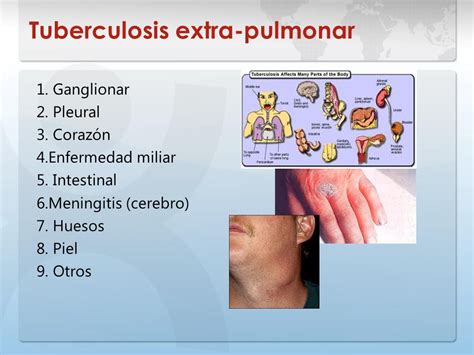 TBC PULMONAR: tuberculosis extrapulmonar