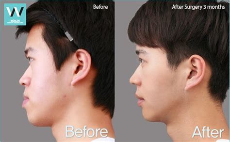 Protruding Mouth Surgery: Getting the Best Facial Aesthetic