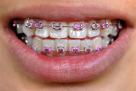 Pink braces stock image. Image of overbite, confidence - 1873825