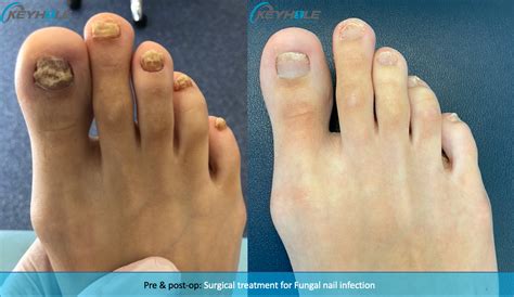 Fungal Nail Laser Treatment Perth | Perth Podiatric Surgery